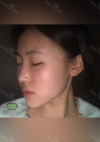 Facial Contour, Chin Reduction, Nose&Eye Surgery After 2 years — Korea cost, reviews & before-after | MISOODA