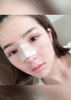 Double eyelids revision & Nose revision :) — Korea cost, reviews & before-after | MISOODA