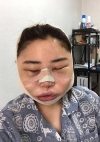 Facial Contour + Revision Nose Surgery — Korea cost, reviews & before-after | MISOODA