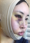 Facial Contour, Chin Reduction, Nose&Eye Surgery After 2 years — Korea cost, reviews & before-after | MISOODA