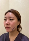 Facial Bone, Lateral canthoplasty — Korea cost, reviews & before-after | MISOODA