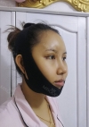 Eye surgery + Under eye fat repositioning + Fat grafting + Facial Bone + Nose — Korea cost, reviews & before-after | MISOODA