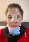 Facial Bone, Nose Surgery, Breast fat graft — Korea cost, reviews & before-after | MISOODA
