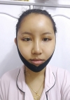 Eye surgery + Under eye fat repositioning + Fat grafting + Facial Bone + Nose — Korea cost, reviews & before-after | MISOODA