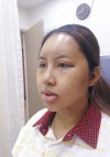 Eye surgery + Under eye fat repositioning + Fat grafting + Facial Bone + Nose — Korea cost, reviews & before-after | MISOODA