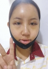Eye surgery + Under eye fat repositioning + Fat grafting + Facial Bone + Nose — Korea cost, reviews & before-after | MISOODA