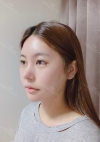 Facial Bone, Lateral canthoplasty — Korea cost, reviews & before-after | MISOODA