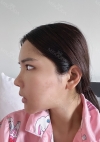 Facial Bone, Nose Surgery, Breast fat graft — Korea cost, reviews & before-after | MISOODA