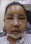 Eye surgery + Under eye fat repositioning + Fat grafting + Facial Bone + Nose — Korea cost, reviews & before-after | MISOODA