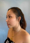 Eye surgery + Under eye fat repositioning + Fat grafting + Facial Bone + Nose — Korea cost, reviews & before-after | MISOODA