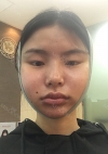 3 in 1 Facial Contouring — Korea cost, reviews & before-after | MISOODA