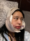 New V-line — Korea cost, reviews & before-after | MISOODA