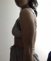 Arm and Braline Liposuction