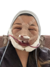 Girin: facial contouring, acculift, rhino, forehead lift, des, epi, fat graft — Korea cost, reviews & before-after | MISOODA