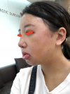 Girin: facial contouring, acculift, rhino, forehead lift, des, epi, fat graft — Korea cost, reviews & before-after | MISOODA