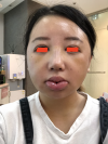 Girin: facial contouring, acculift, rhino, forehead lift, des, epi, fat graft — Korea cost, reviews & before-after | MISOODA