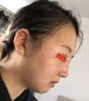 Girin: facial contouring, acculift, rhino, forehead lift, des, epi, fat graft — Korea cost, reviews & before-after | MISOODA