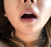 Girin: facial contouring, acculift, rhino, forehead lift, des, epi, fat graft — Korea cost, reviews & before-after | MISOODA