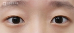 Mine Plastic Surgery, Reviews, Images, Promotions — Korea cost, reviews & before-after | MISOODA