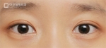 Mine Plastic Surgery, Reviews, Images, Promotions — Korea cost, reviews & before-after | MISOODA