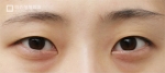 Mine Plastic Surgery, Reviews, Images, Promotions — Korea cost, reviews & before-after | MISOODA