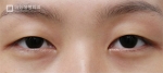 Mine Plastic Surgery, Reviews, Images, Promotions — Korea cost, reviews & before-after | MISOODA