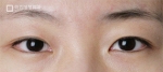 Mine Plastic Surgery, Reviews, Images, Promotions — Korea cost, reviews & before-after | MISOODA