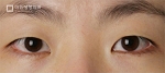 Mine Plastic Surgery, Reviews, Images, Promotions — Korea cost, reviews & before-after | MISOODA