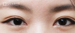 Mine Plastic Surgery, Reviews, Images, Promotions — Korea cost, reviews & before-after | MISOODA