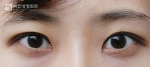 Mine Plastic Surgery, Reviews, Images, Promotions — Korea cost, reviews & before-after | MISOODA