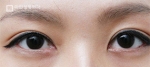 Mine Plastic Surgery, Reviews, Images, Promotions — Korea cost, reviews & before-after | MISOODA