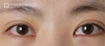 Mine Plastic Surgery, Reviews, Images, Promotions — Korea cost, reviews & before-after | MISOODA