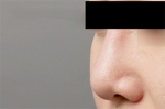 Mine Plastic Surgery, Reviews, Images, Promotions — Korea cost, reviews & before-after | MISOODA