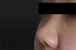 Mine Plastic Surgery, Reviews, Images, Promotions — Korea cost, reviews & before-after | MISOODA
