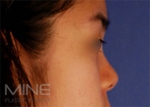 Mine Plastic Surgery, Reviews, Images, Promotions — Korea cost, reviews & before-after | MISOODA