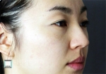 Mine Plastic Surgery, Reviews, Images, Promotions — Korea cost, reviews & before-after | MISOODA
