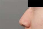 Mine Plastic Surgery, Reviews, Images, Promotions — Korea cost, reviews & before-after | MISOODA