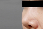 Mine Plastic Surgery, Reviews, Images, Promotions — Korea cost, reviews & before-after | MISOODA