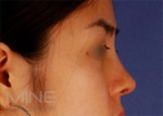 Mine Plastic Surgery, Reviews, Images, Promotions — Korea cost, reviews & before-after | MISOODA