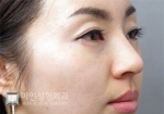 Mine Plastic Surgery, Reviews, Images, Promotions — Korea cost, reviews & before-after | MISOODA