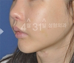April 31 Plastic Surgery,Reviews,Images,Promotions — Korea cost, reviews & before-after | MISOODA