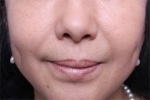 Deesse Plastic Surgery, Reviews,Images, Promotions — Korea cost, reviews & before-after | MISOODA