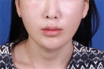 Deesse Plastic Surgery, Reviews,Images, Promotions — Korea cost, reviews & before-after | MISOODA
