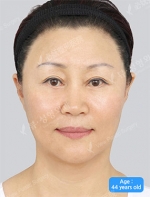 View Plastic Surgery, Reviews, Images, Promotions — Korea cost, reviews & before-after | MISOODA