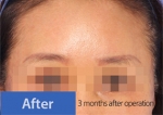face lift