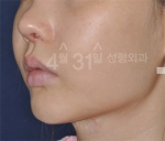 April 31 Plastic Surgery,Reviews,Images,Promotions — Korea cost, reviews & before-after | MISOODA