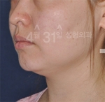 April 31 Plastic Surgery,Reviews,Images,Promotions — Korea cost, reviews & before-after | MISOODA
