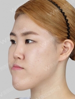 facial contouring