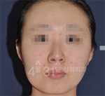 April 31 Plastic Surgery,Reviews,Images,Promotions — Korea cost, reviews & before-after | MISOODA