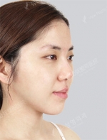 View Plastic Surgery, Reviews, Images, Promotions — Korea cost, reviews & before-after | MISOODA